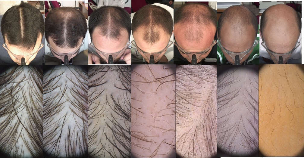 alopecia-androgenetica