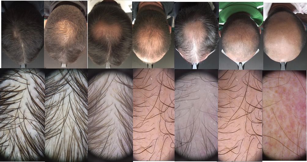 alopecia-androgenetica