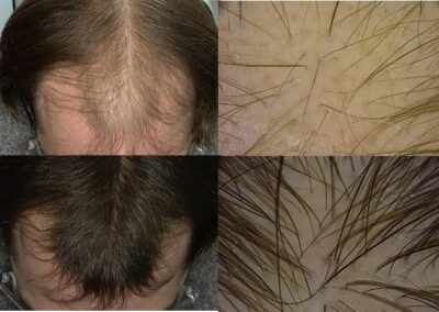 alopecia-androgenetica-prima-e-dopo-5-1