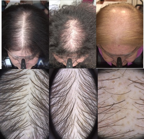 alopecia-androgentica