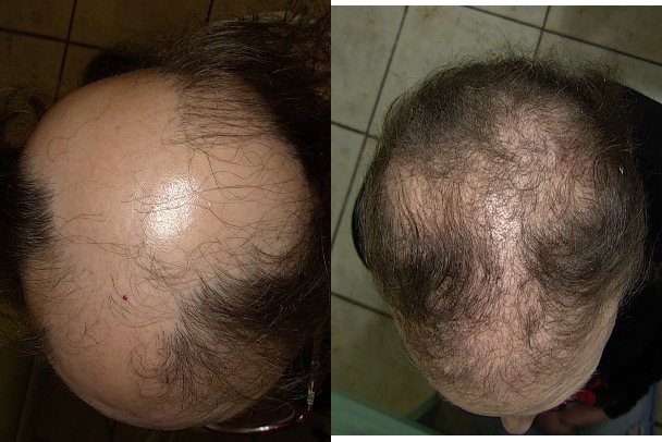 alopecia-areata-prima-e-dopopng