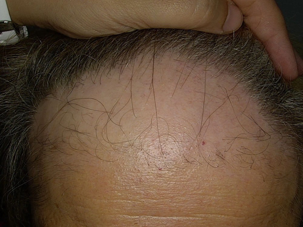 alopecia-fibrosante-frontale-Tricologia