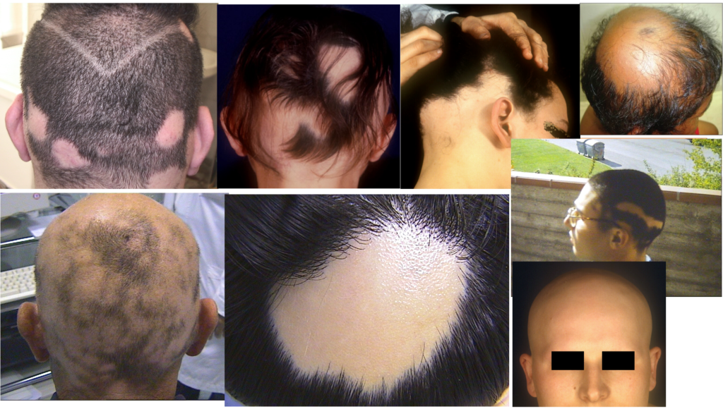 Alopecia areata