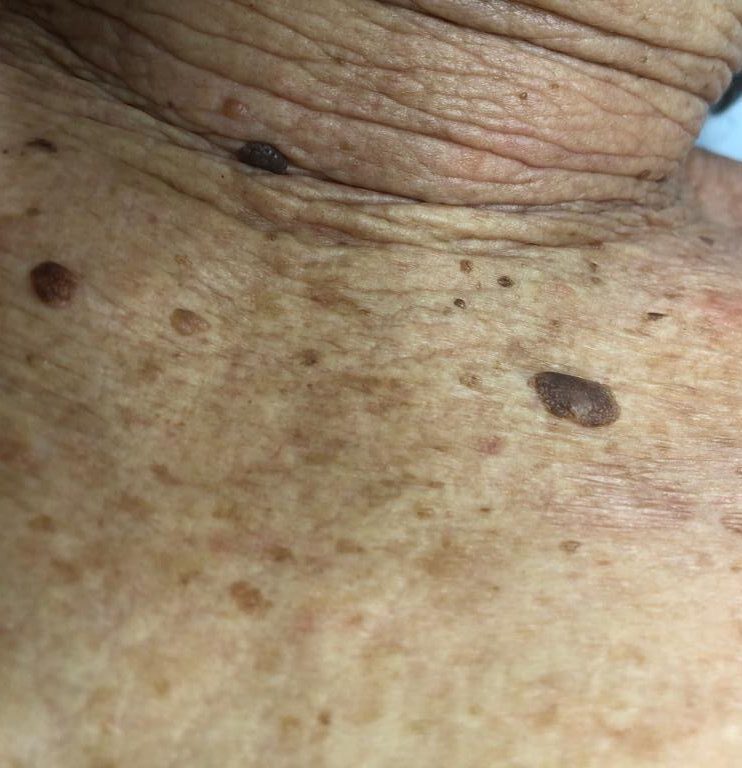 fibromi-penduli-cheratosi-medicina-estetica-e1620063839268