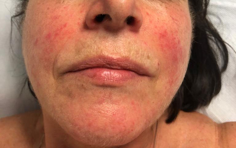 rosacea