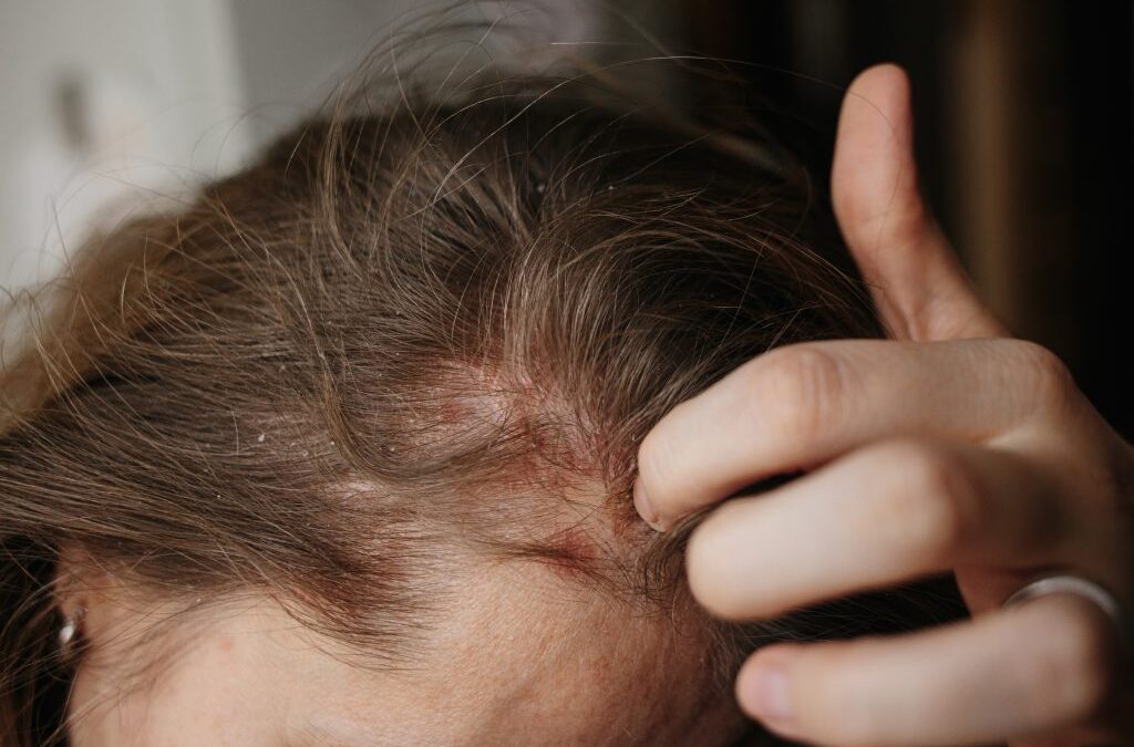Covid 19 e capelli: come prevenire e trattare la caduta?